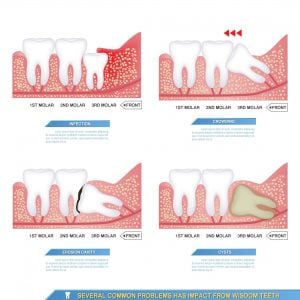 Wisdom Teeth removal