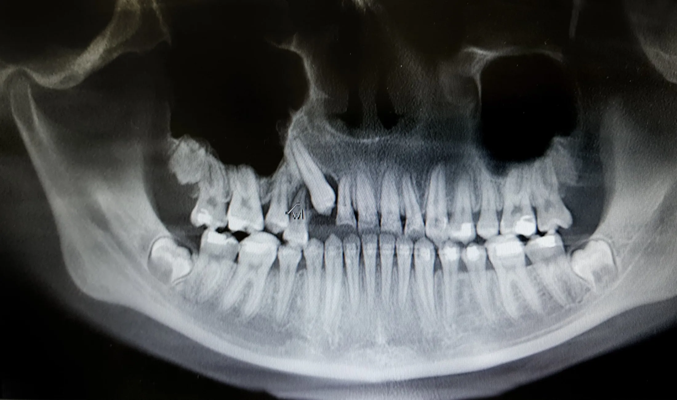 Facial Trauma